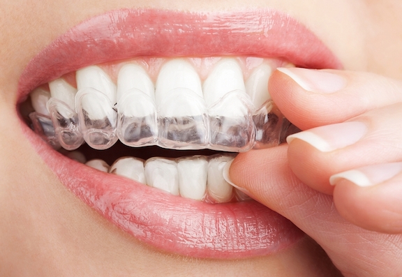 Invisalign Pros and Cons