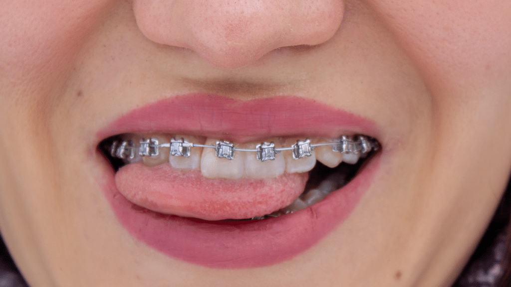 How Long Do I Have to Wear Braces?