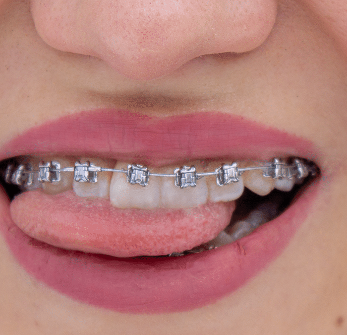 How Long Do I Have to Wear Braces?