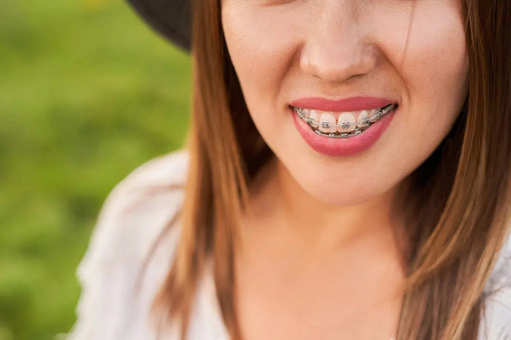 Is 40 Too Old for Braces? Dr. Bob Bryan Orthodontics