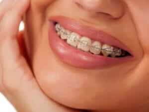 clear braces vs Invisalign