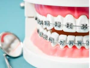 Braces for Adults