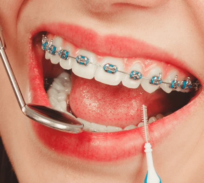 cost of braces in pennsylvania