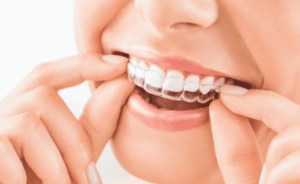 Orthodontist Allentown Advice: Proven Tips to Choose Braces or Invisalign