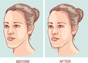 Jaw Surgery: A Comprehensive Guide to Preparation and Recovery