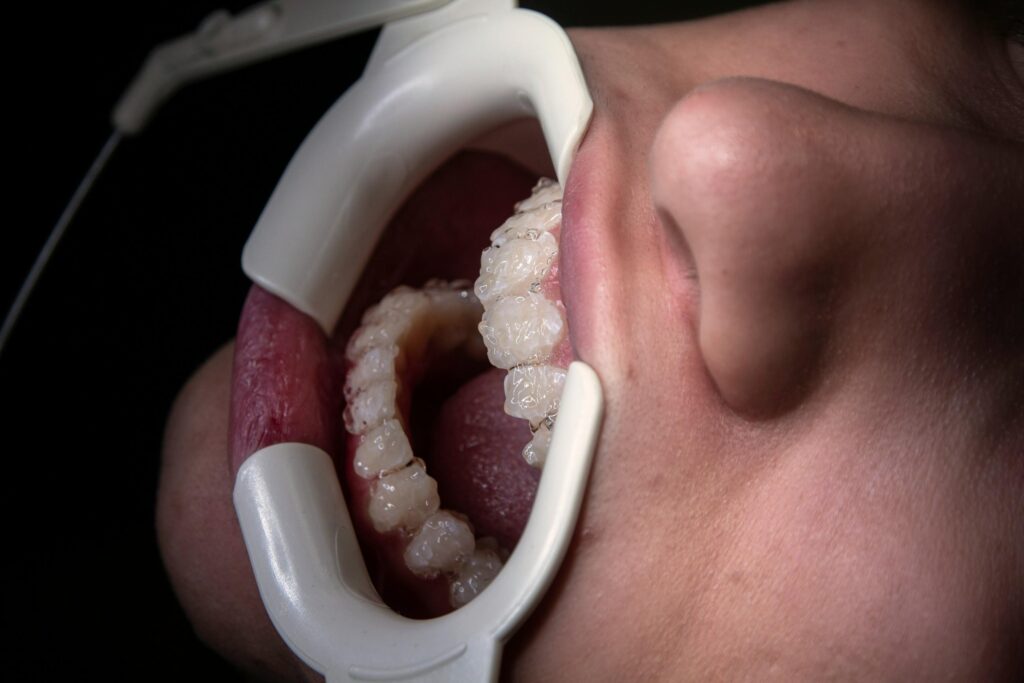 Jaw Surgery Speech: Key Changes and Recovery Insights