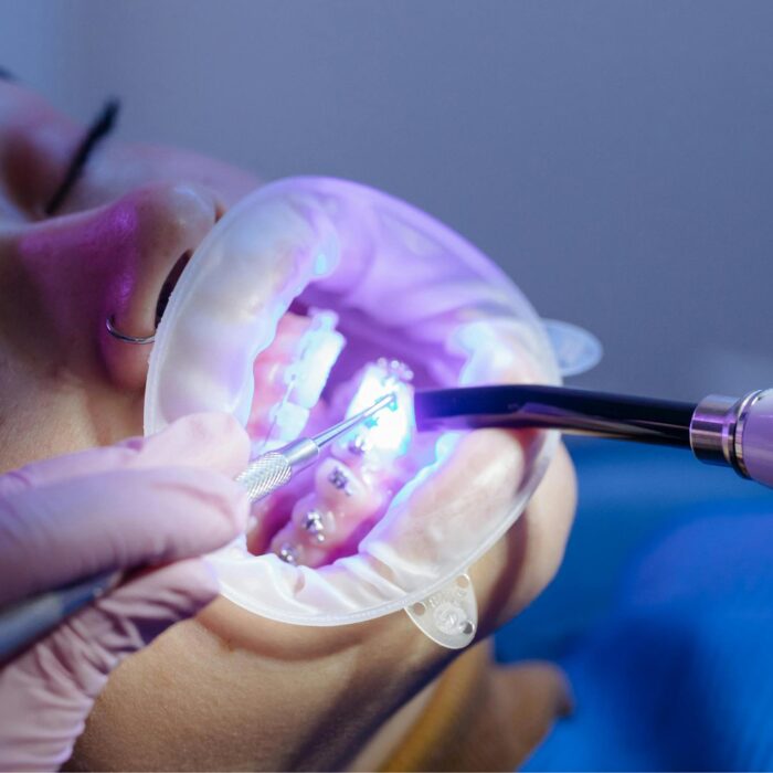 Orthodontist Allentown Advice: Proven Tips to Choose Braces or Invisalign