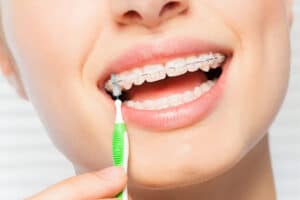 How to Take Care of Braces with Daily Cleaning