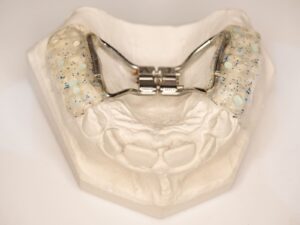 Midline gap from expander treatment during orthodontic care