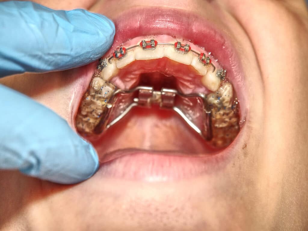 Orthodontic expander gap explained by orthodontist in Allentown PA