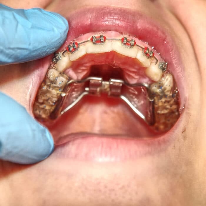 Orthodontic expander gap explained by orthodontist in Allentown PA