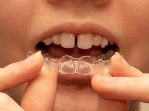 Child holding clear aligner during orthodontics for kids treatment