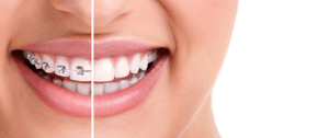 Close-up smile showing braces removed, highlighting the retention phase after braces for lasting alignment