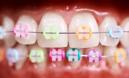 Close-up of teeth with braces, rubber bands helping guide bite alignment