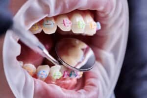 Orthodontist adjusting elastic bands for braces during a routine visit