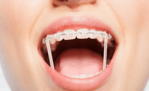 Clear braces with orthodontic rubber bands placed to assist jaw movement