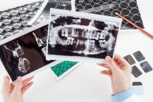 Dentist reviewing dental X-rays showing jaw alignment during jaw surgery recovery planning